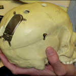 NeuroPace-implant-mozyk