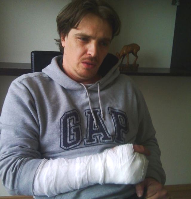 Счупиха пръстите  на дясната ръка на журналиста Васил Петев от big5.bg!